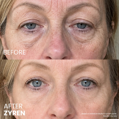 Before and after Zyren Contour Lift Eye Cream: close-up of a woman's eyes with less visible under-eye bags after