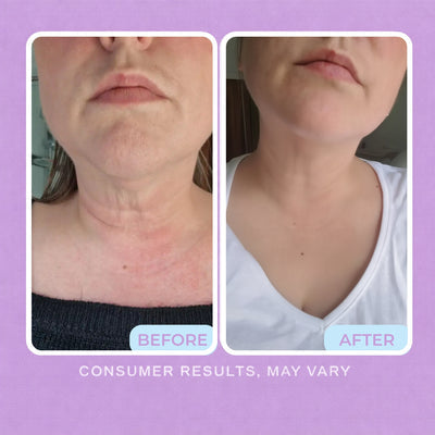 Before and after photos of a woman's neck and chest, with less redness and softer-looking lines after