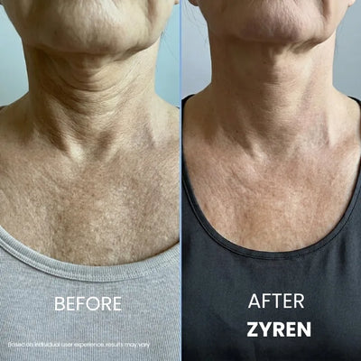Before and after Zyren Tighten & Lift Neck Cream: woman's neck and chest, with softer-looking lines in the after photo