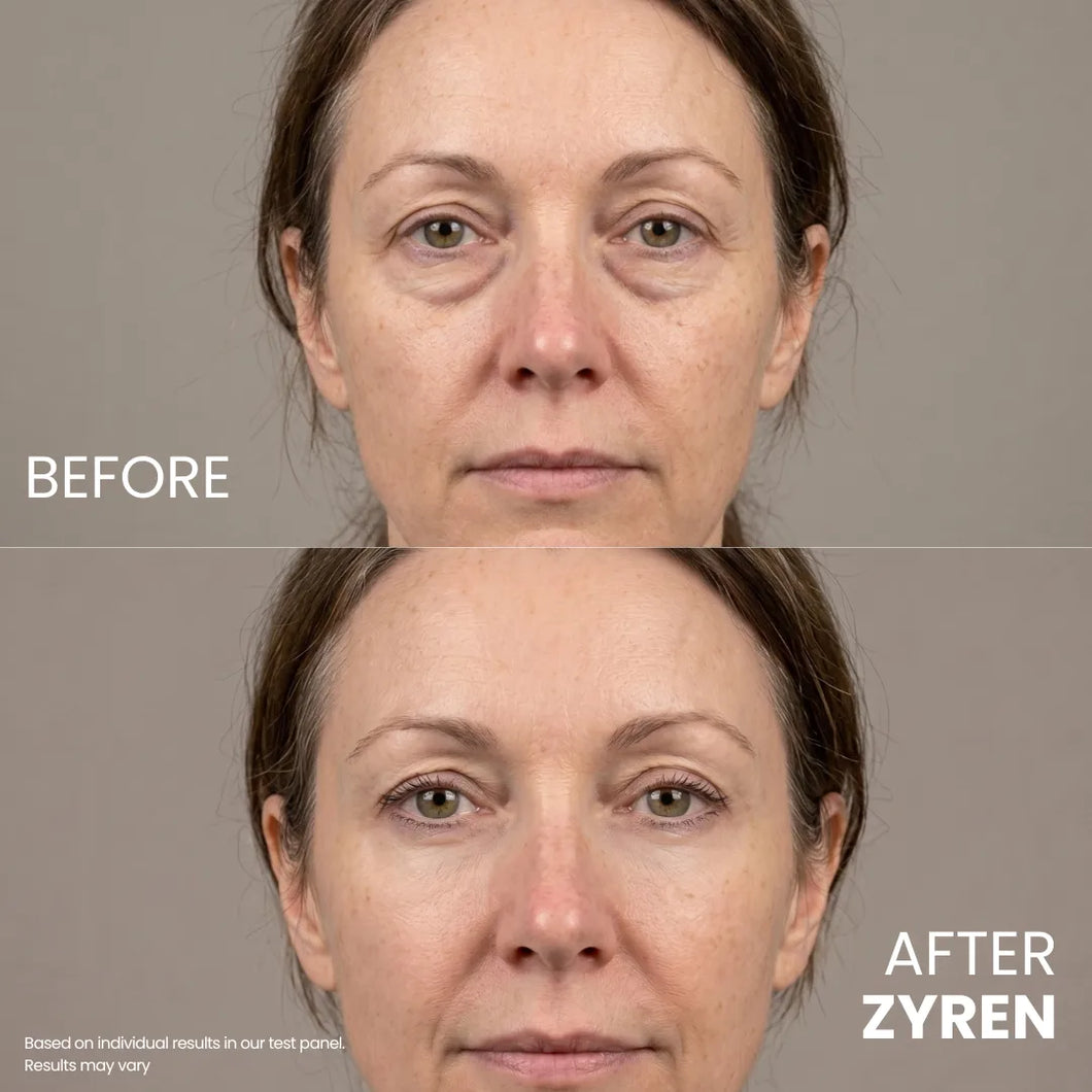 Before and after Zyren Contour Lift Eye Cream: woman's face with less puffy, brighter-looking under-eyes after