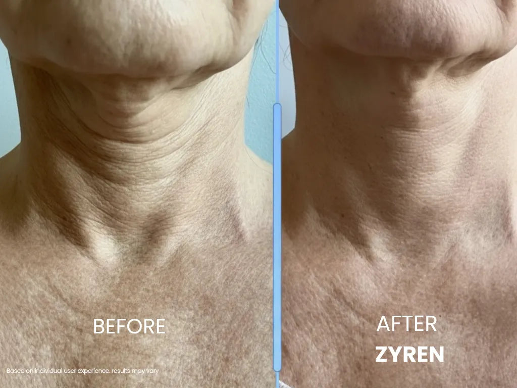 Before and after using Zyren: close-up of a woman's neck, with creases looking softer in the after photo