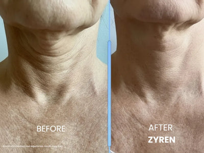 Before and after using Zyren: close-up of a woman's neck, with creases looking softer in the after photo