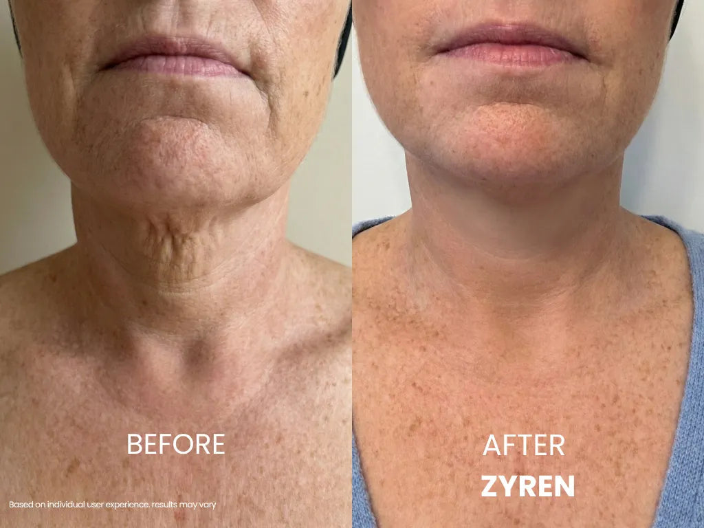 Before and after using Zyren: woman's neck looks smoother, with less visible crepey folds in the after photo